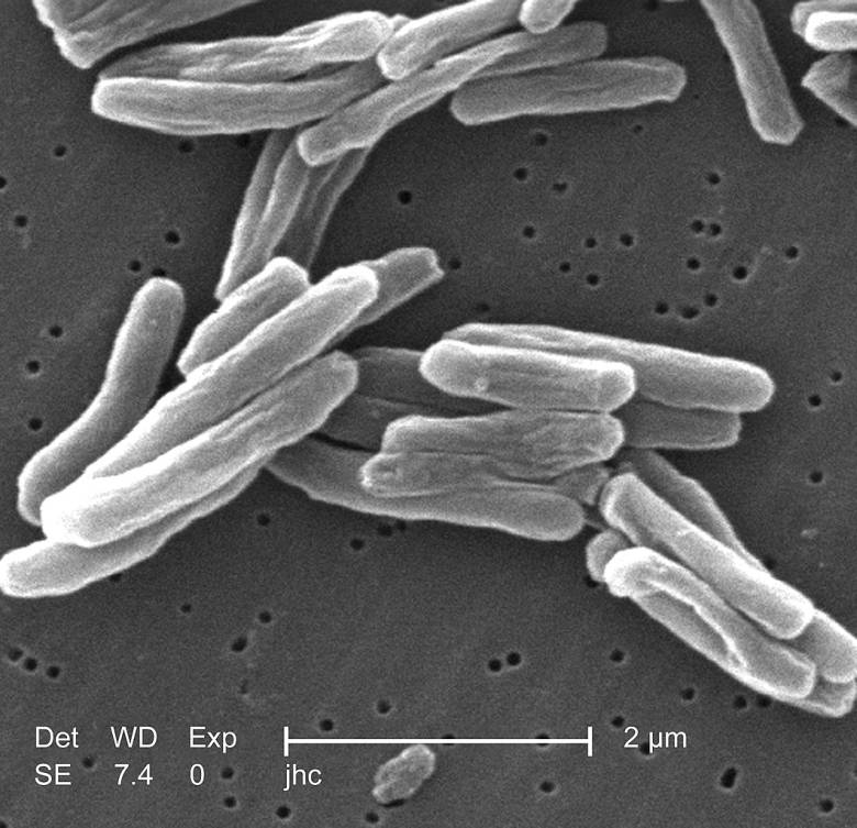 tuberculosis