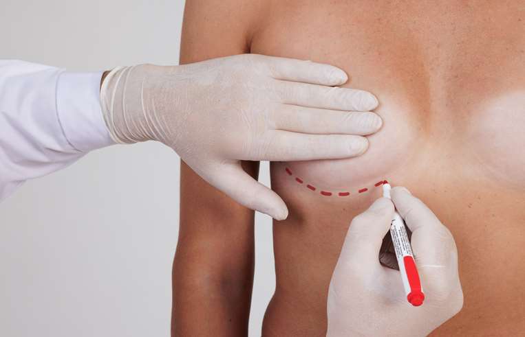 Implantes de senos