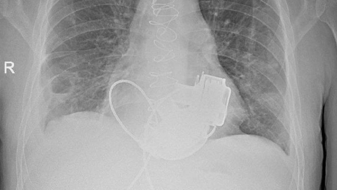 Hito médico: la historia de un paciente terminal sin pulso que fue salvado en Rusia