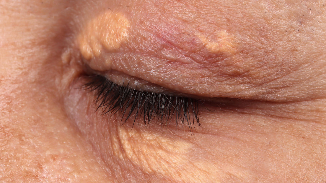 Lo que unas manchas alrededor de los ojos podrían decir sobre tu salud